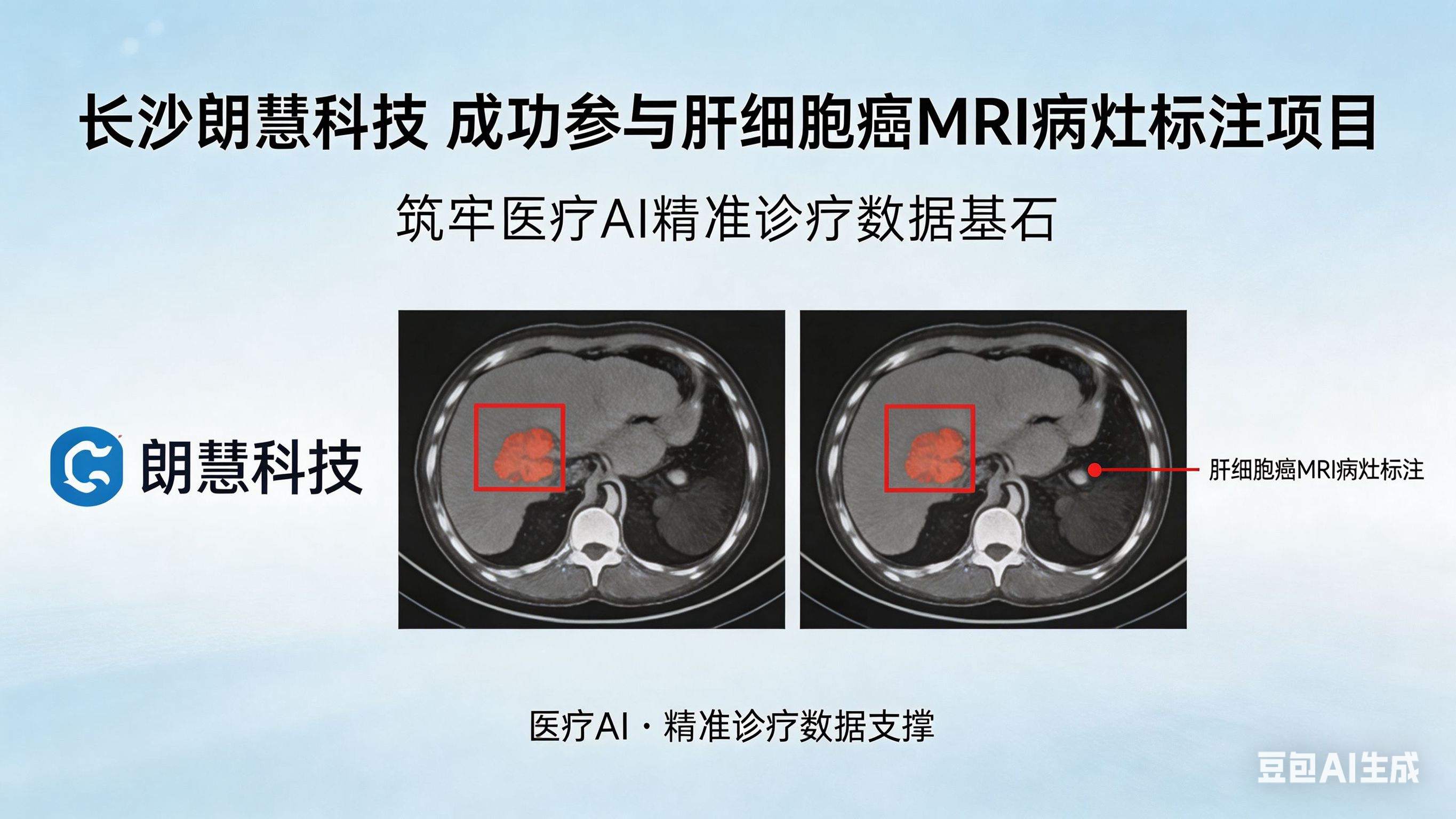 长沙朗慧科技参与肝细胞癌MRI病灶标注项目新闻稿.png 长沙朗慧科技参与肝细胞癌MRI病灶标注项目新闻稿.png